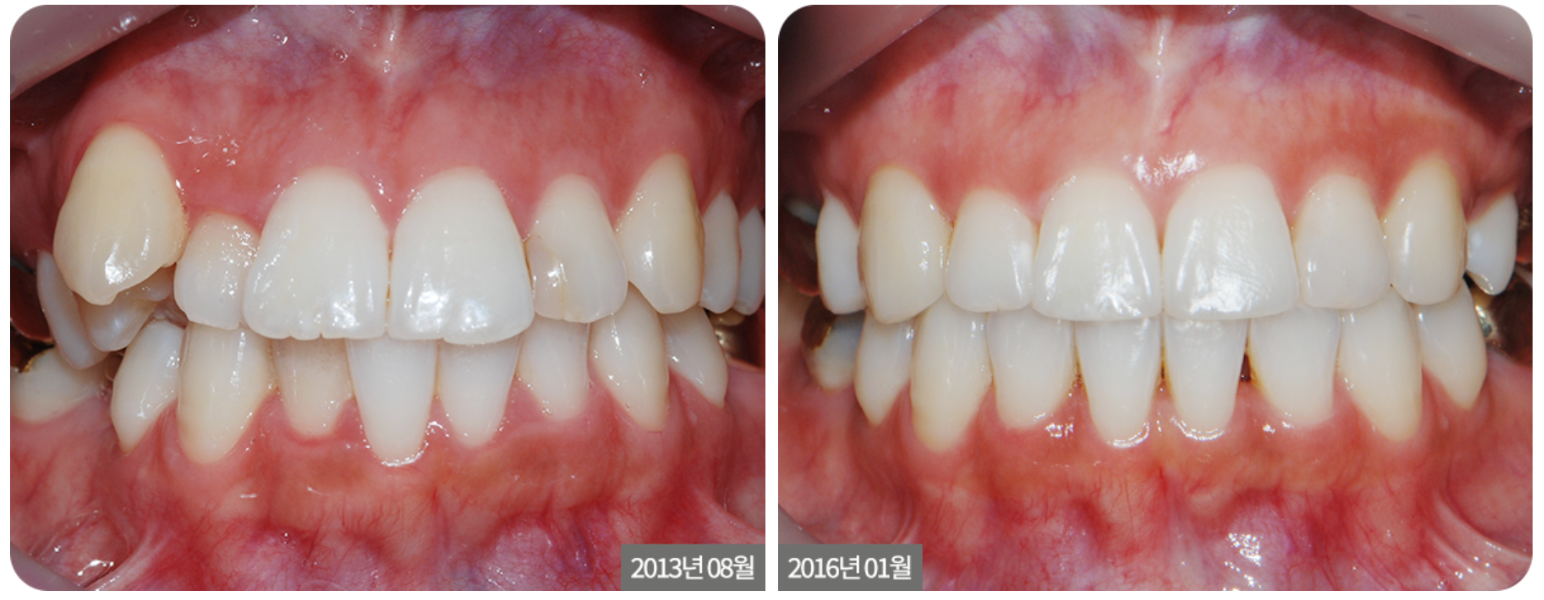 Orthodontic Treatment for Crowded Teeth