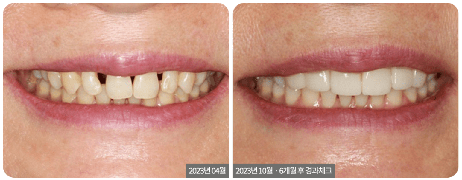 No-Prep Veneers for Teeth Gaps
