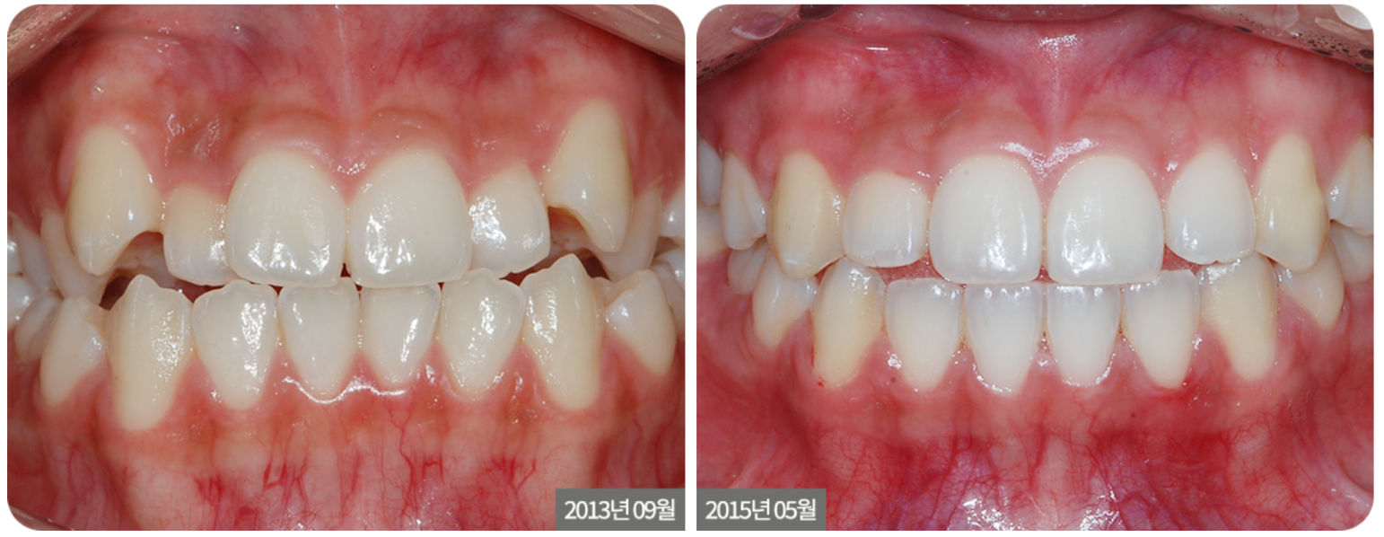 Crowding with Mandibular Correction