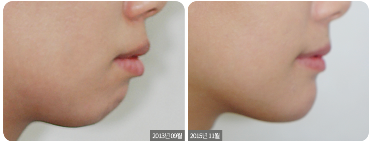 Orthodontic Treatment for Protruding Teeth