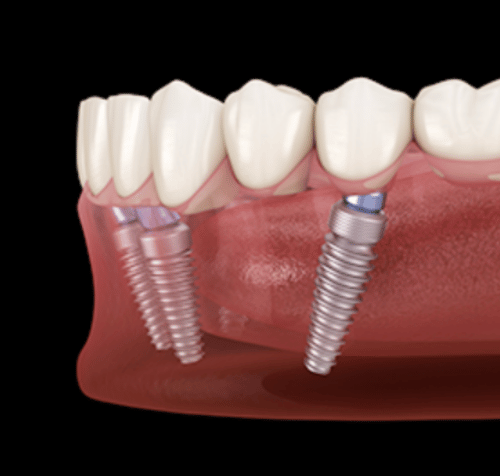 3D rendering of dental implants in a jaw, showing titanium screws and attached teeth, set against a black background.