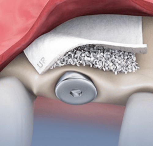 Dental illustration of a bone graft and membrane over a dental implant. Red gums, white membrane, and silver implant are visible.