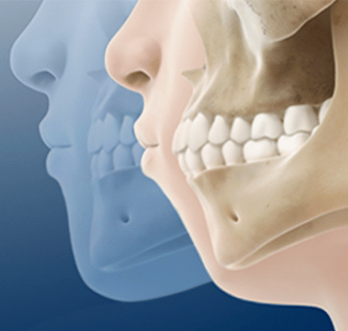Anatomical illustration of a human jaw from a side view. Shows bone structure, teeth, and profile of the face.
