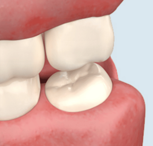 Close-up of teeth, showing an impacted molar pushing against adjacent teeth. Red gums and white teeth are visible.