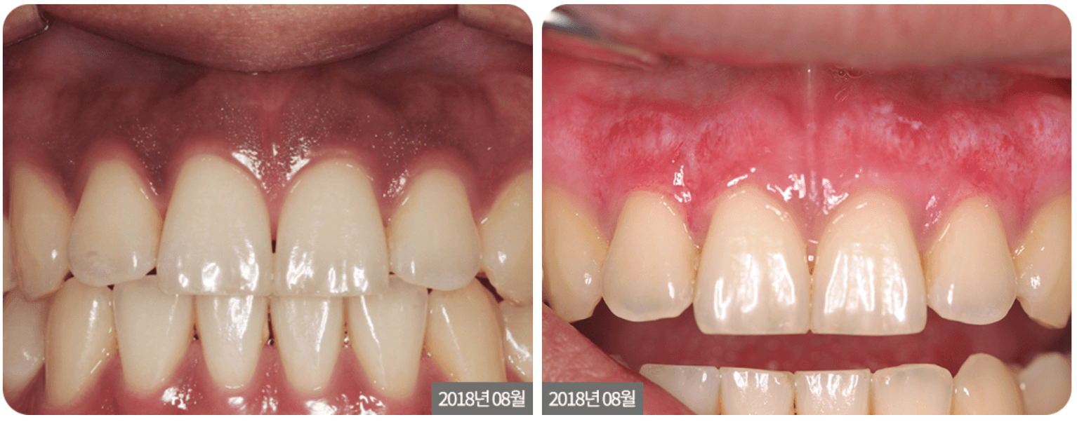 Gum Whitening (Depigmentation) 