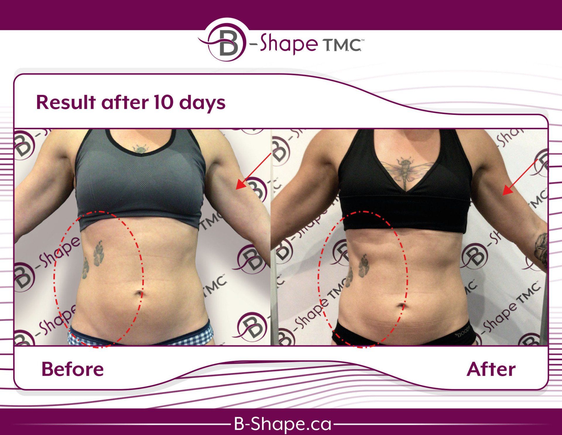 Side-by-side comparison shows a woman's midsection before and after a 10-day B-Shape treatment, claiming visible results.