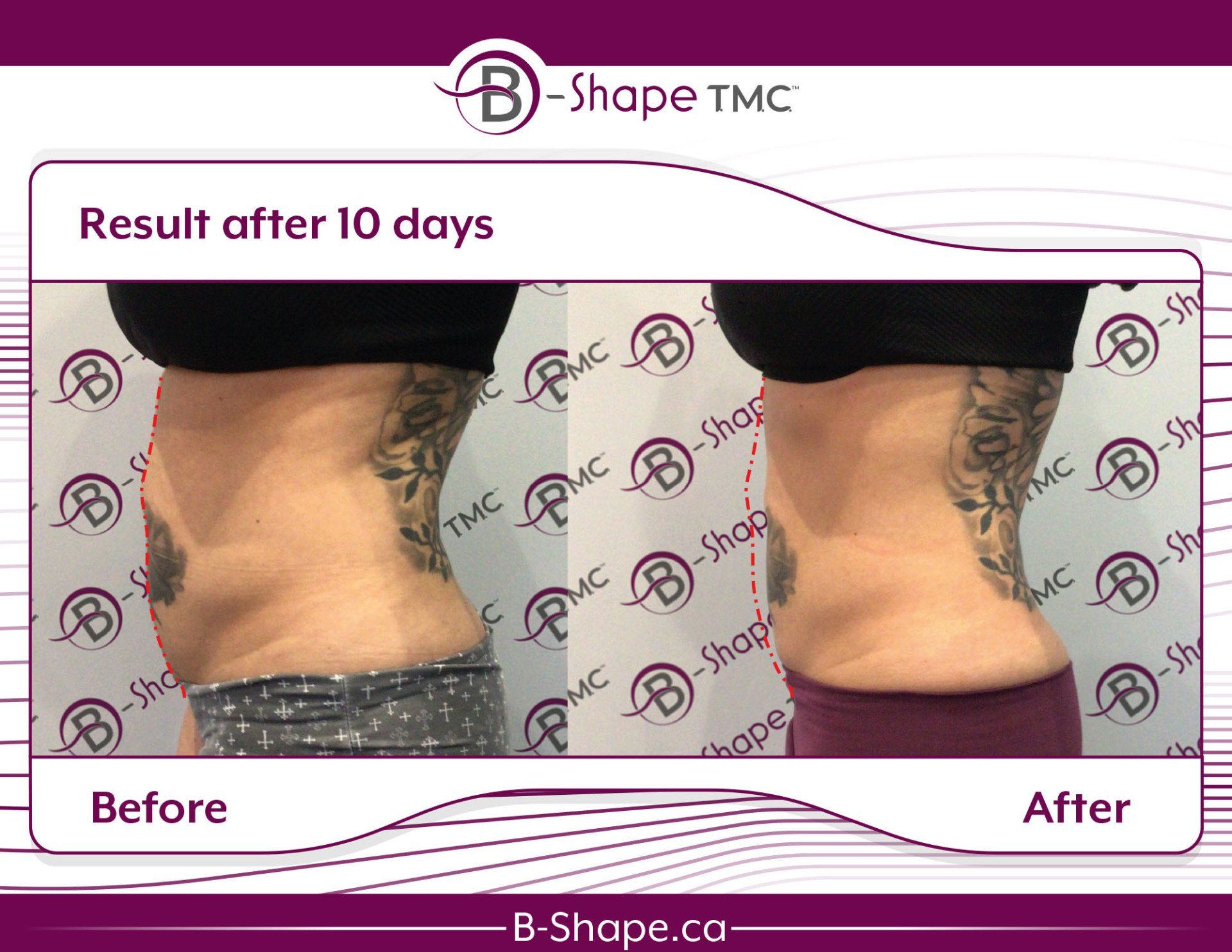 Side-by-side comparison: Before and after B-Shape treatment showing reduced waistline after 10 days.