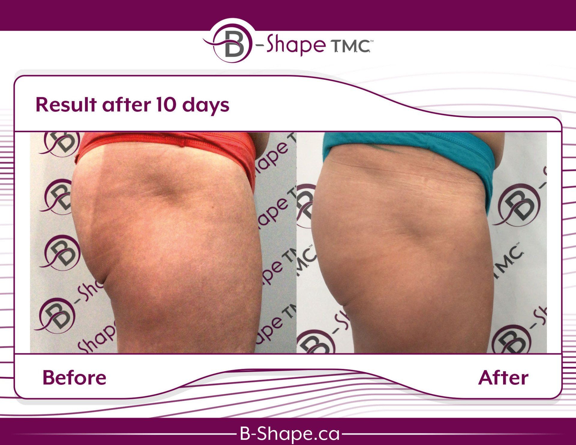 Side-by-side photo comparing a person's buttocks before and after a 10-day B-Shape treatment, showing a reduction in cellulite.