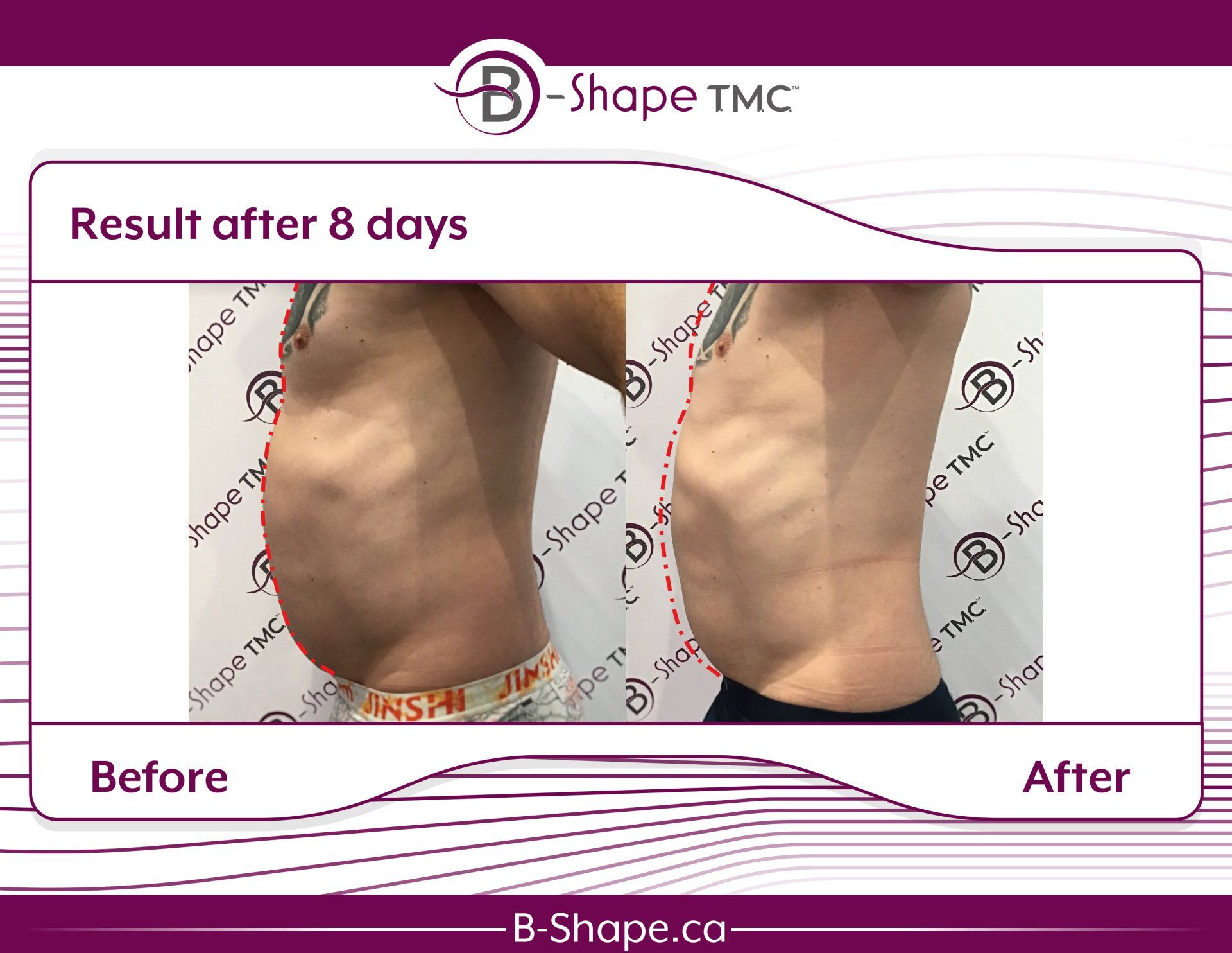 Side-by-side comparison of a person's torso before and after 8 days of B-Shape TMC treatment, showing a reduction in belly fat.