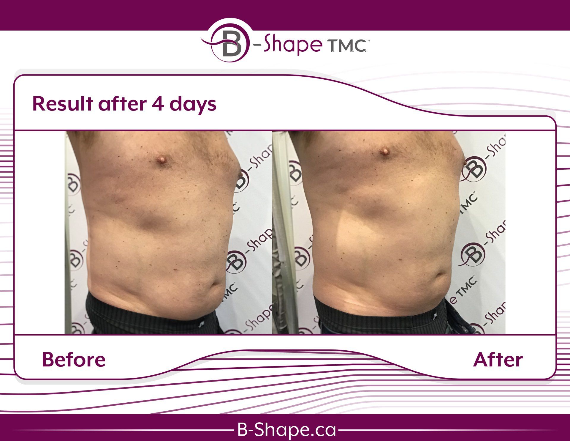Side-by-side photos of a man's torso before and after a 4-day B-Shape TMC treatment, showing a slight reduction in fat.