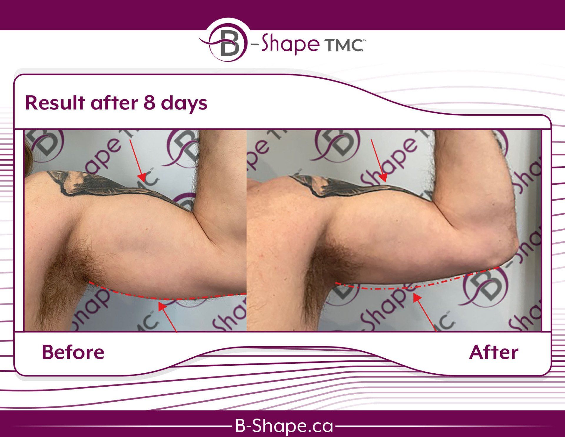 Side-by-side comparison: arm before and after 8 days, claimed results of B-Shape TMC.
