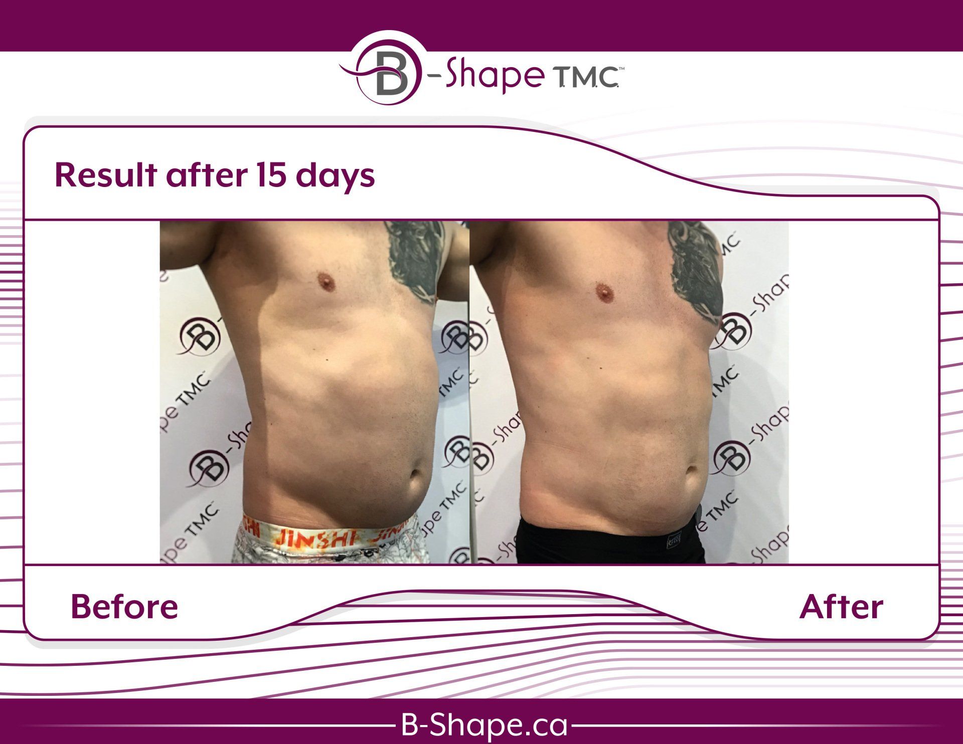 Side-by-side comparison of a man's torso before and after 15 days of B-Shape TMC treatment, showing a reduced abdomen.