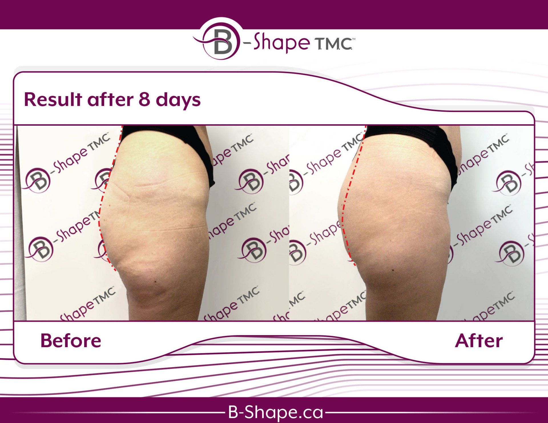 Side-by-side view of woman's thigh before and after a B-Shape TMC treatment, showing reduced cellulite after 8 days.