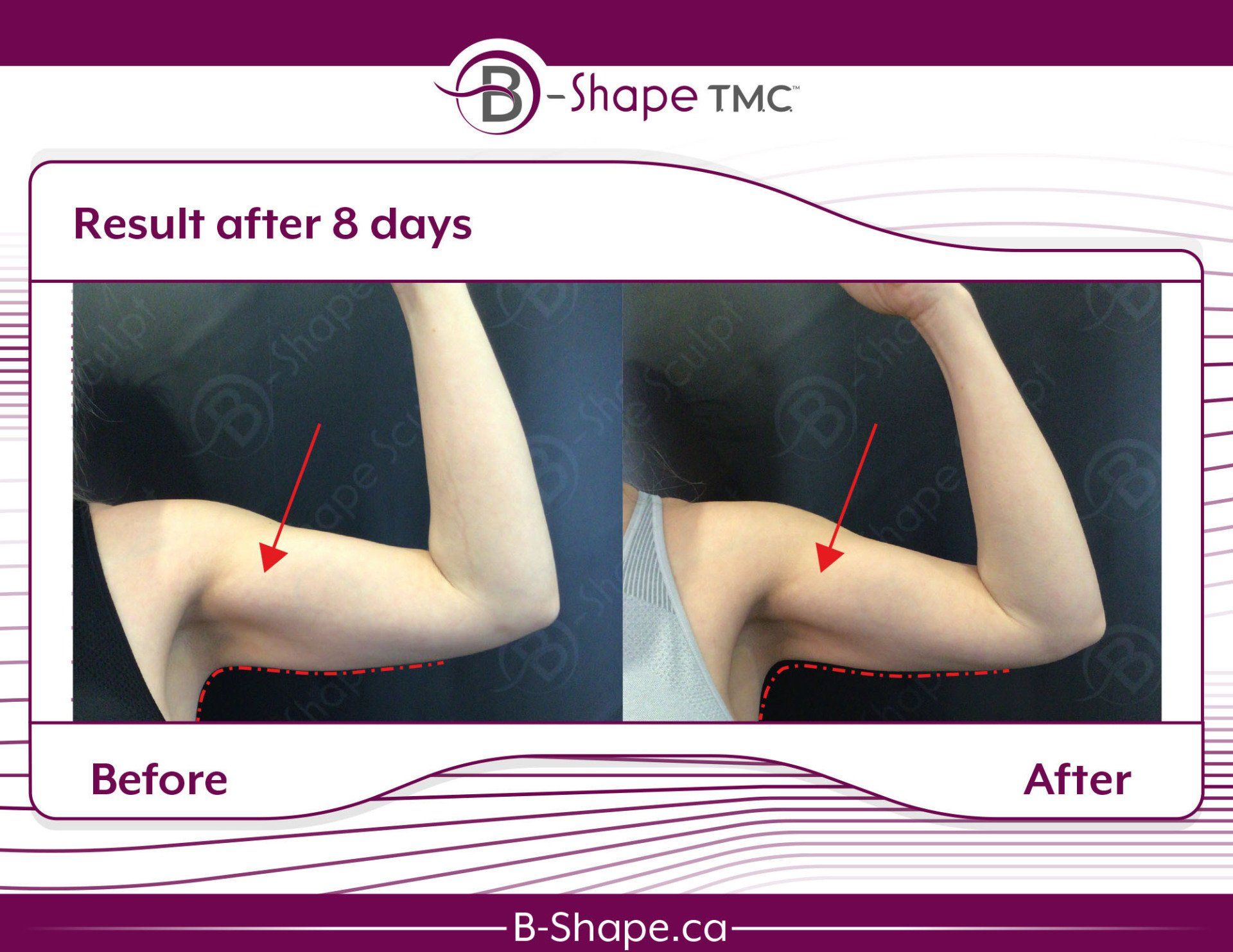 Side-by-side arm comparison: Before & after 8 days of B-Shape TMC treatment, showing a reduction in arm circumference.