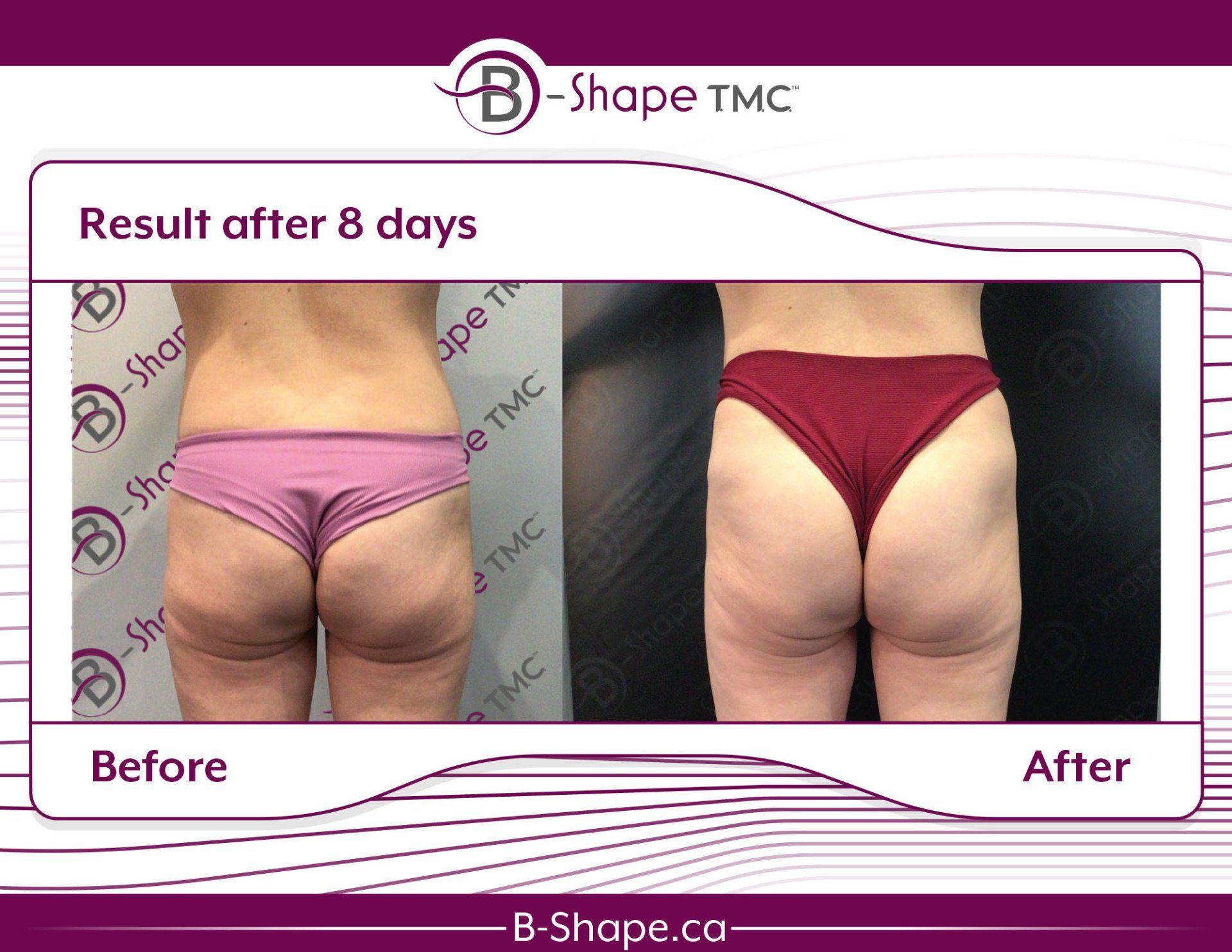 Before and after view of a woman's buttock, showing cellulite reduction after 8 days of B-Shape TMC treatment.