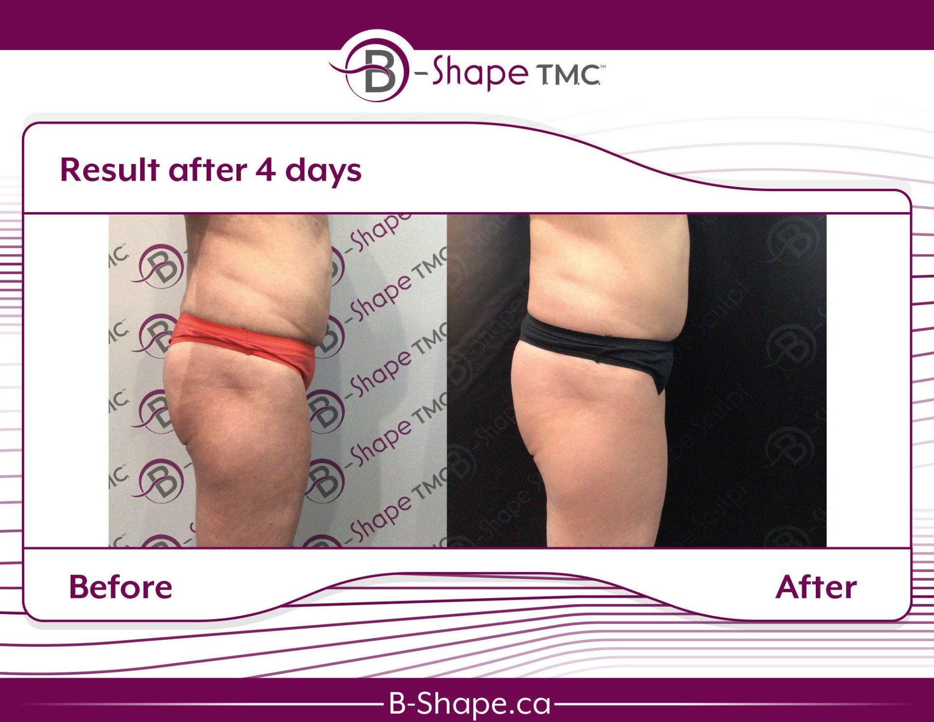 Side-by-side comparison of a person's buttock before (red underwear) and after (black underwear) a B-Shape TMC treatment.