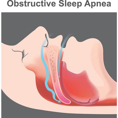 Obstructive Sleep Apnea — Bourbonnais, IL — David E. Krause, M.D., Ltd.