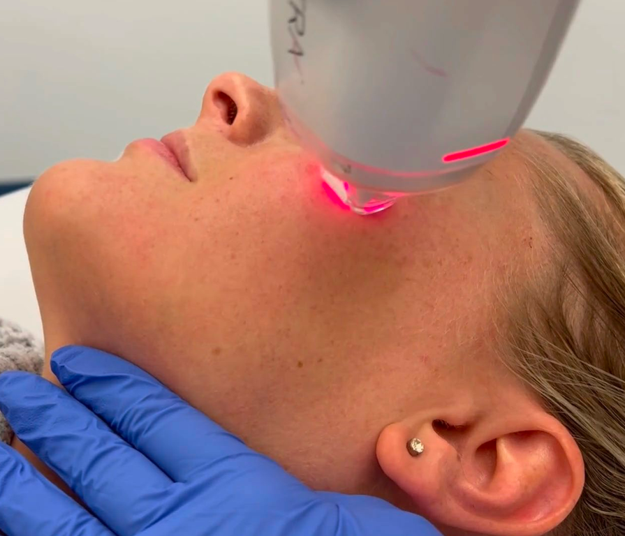 A woman is getting a laser treatment on her face.