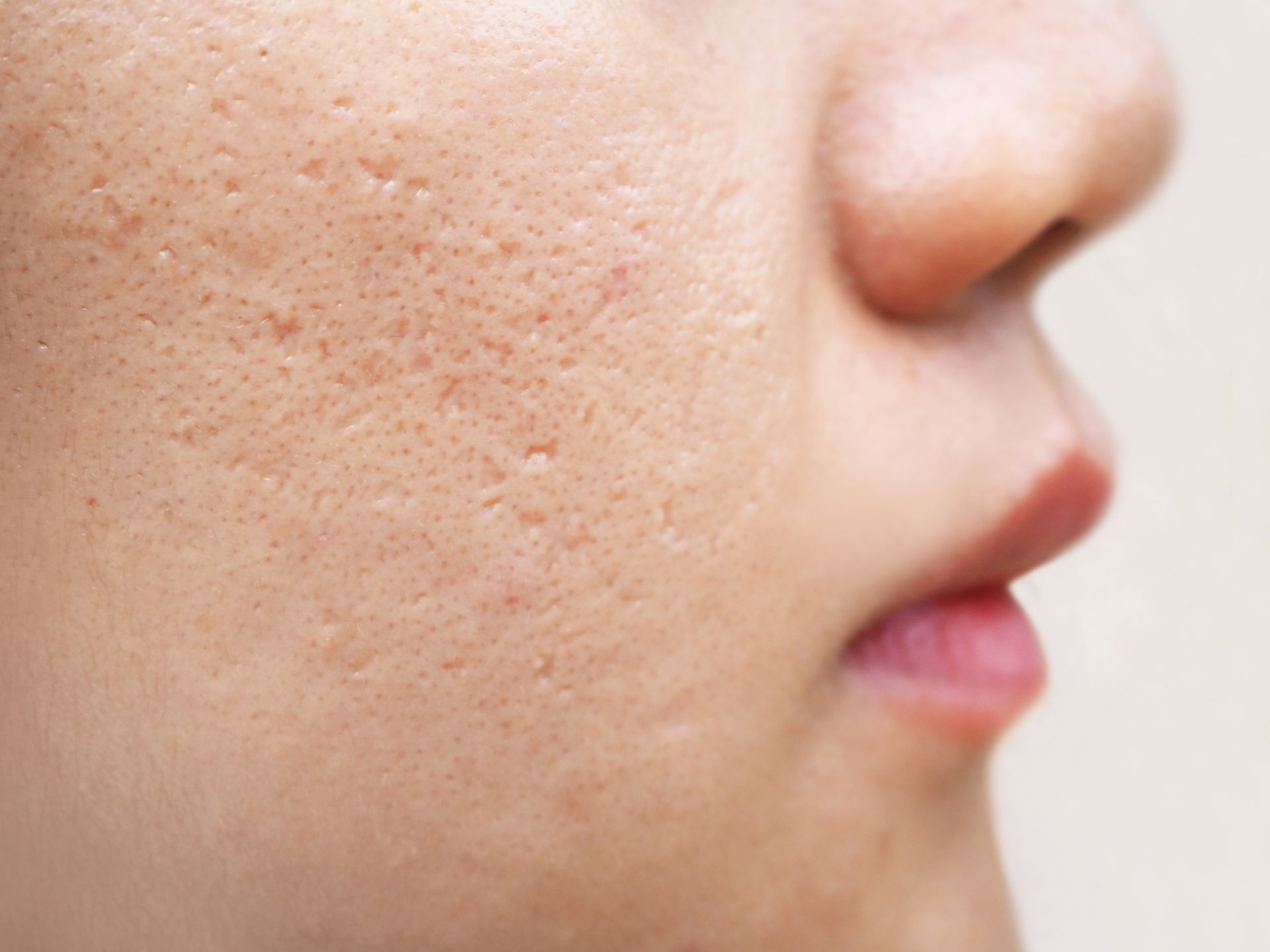 A close up of a person 's face with acne on it.