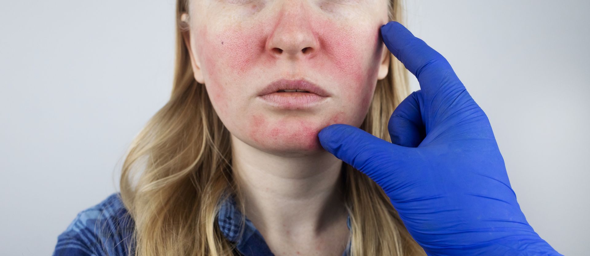 A woman with red spots on her face is being examined by a doctor.