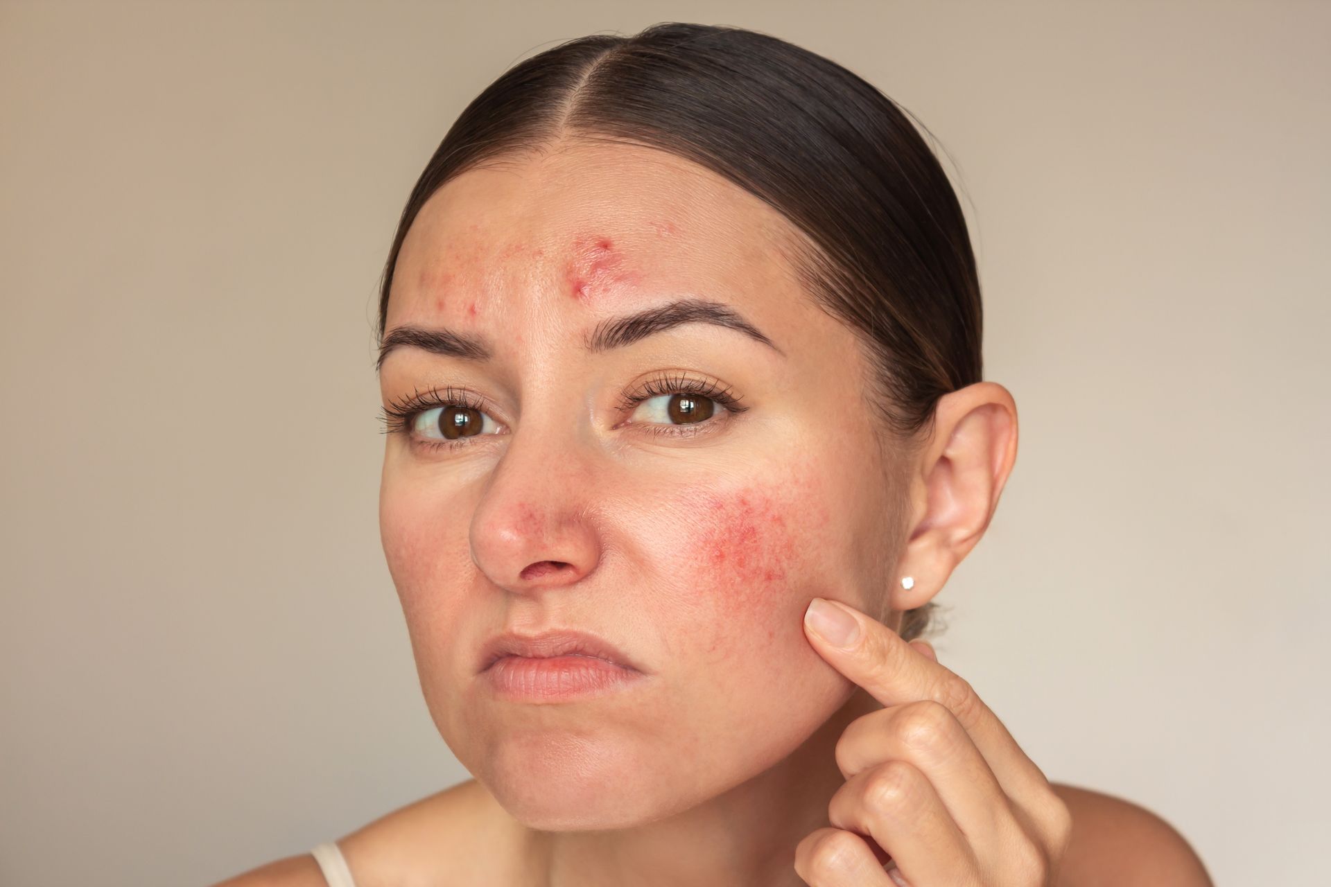 A woman with acne on her face is pointing at her face.