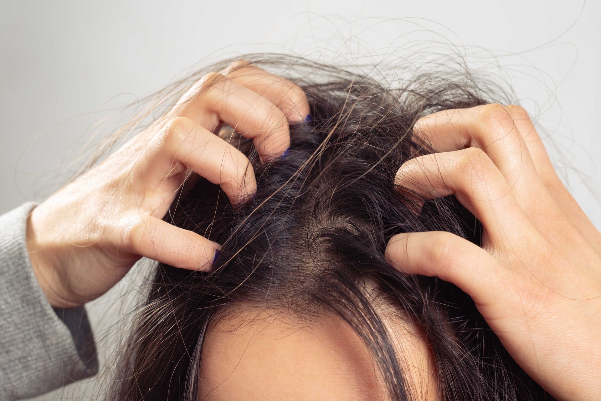 Person scratching their scalp with both hands, likely due to itchiness.