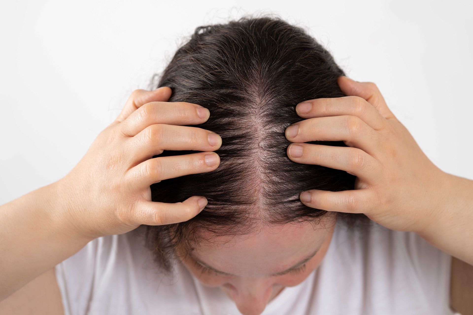 Person's scalp with visible hair thinning. Hands touching the head, white background.