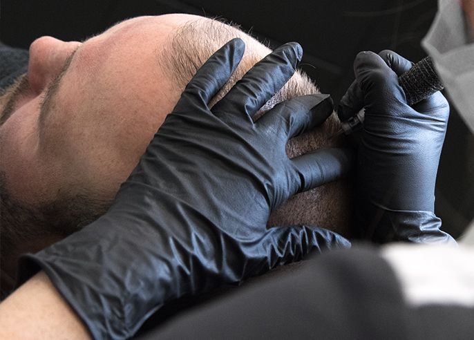 Person receiving scalp micropigmentation; technician's gloved hands applying pigment to head.