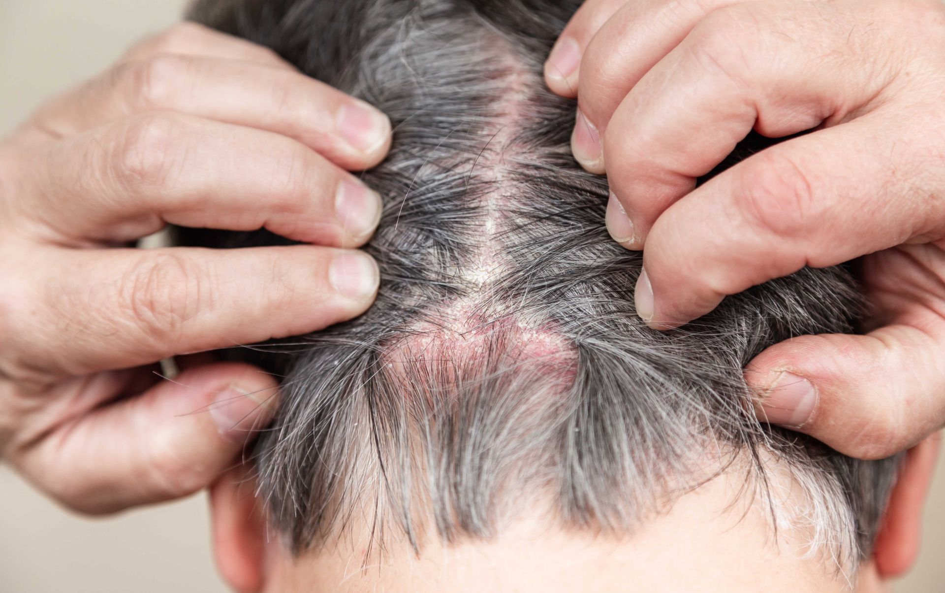 Hands parting gray hair, revealing irritated scalp.