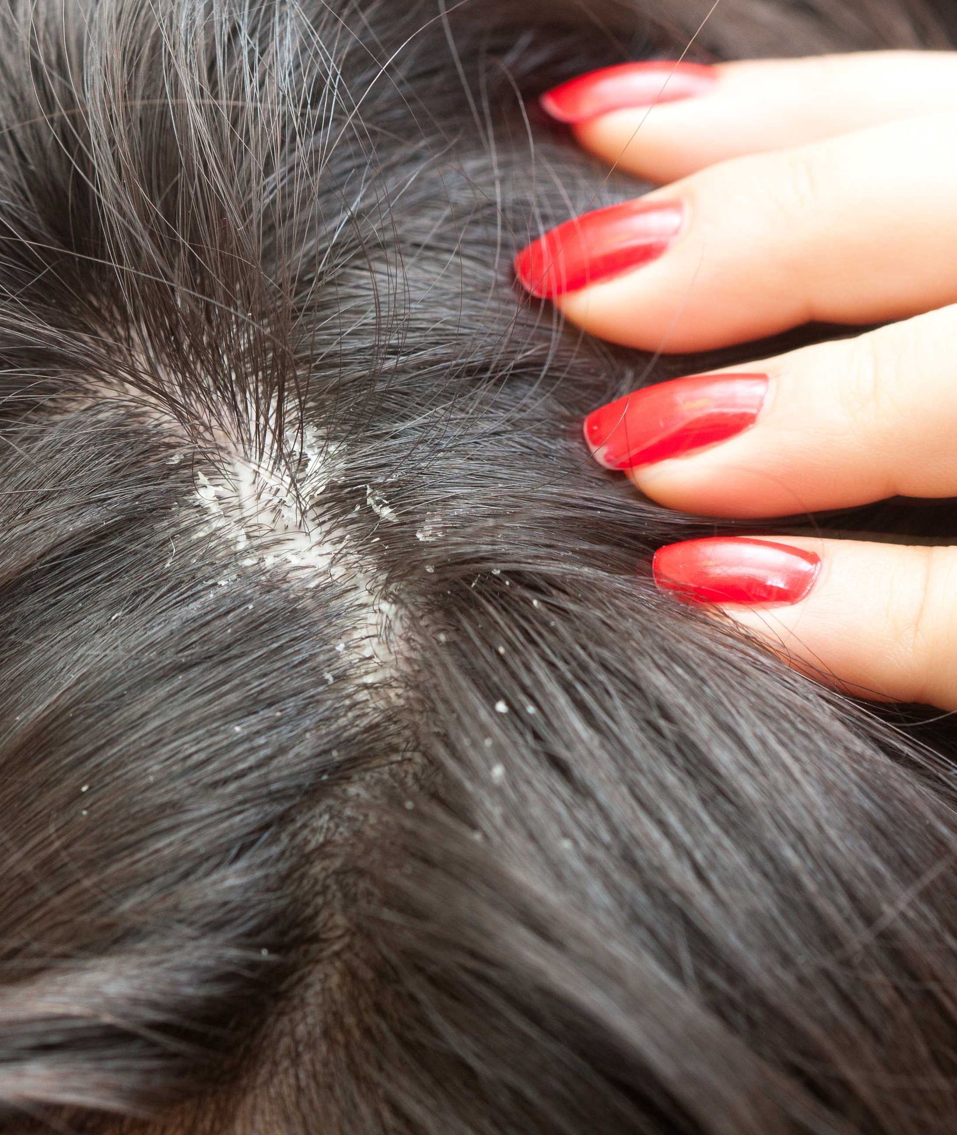 Hand touching dark hair with visible dandruff.