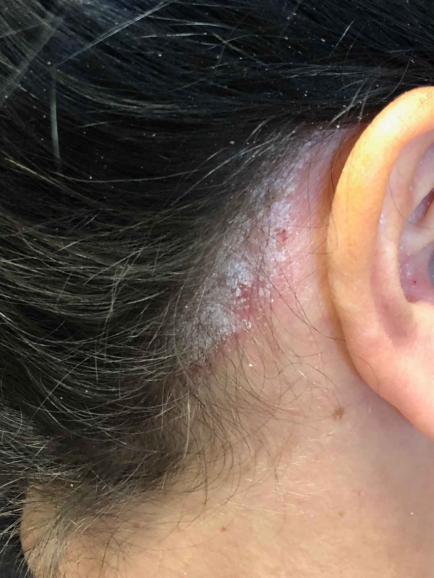 Scaly, irritated skin near the ear on a head with dark hair.