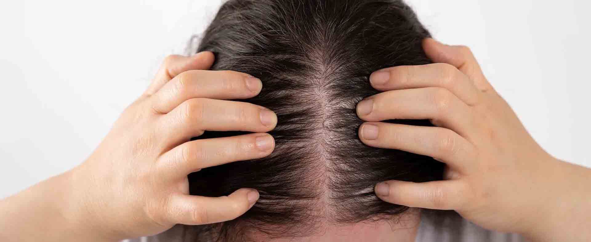Person's scalp with visible hair thinning. Hands touching the head, white background.