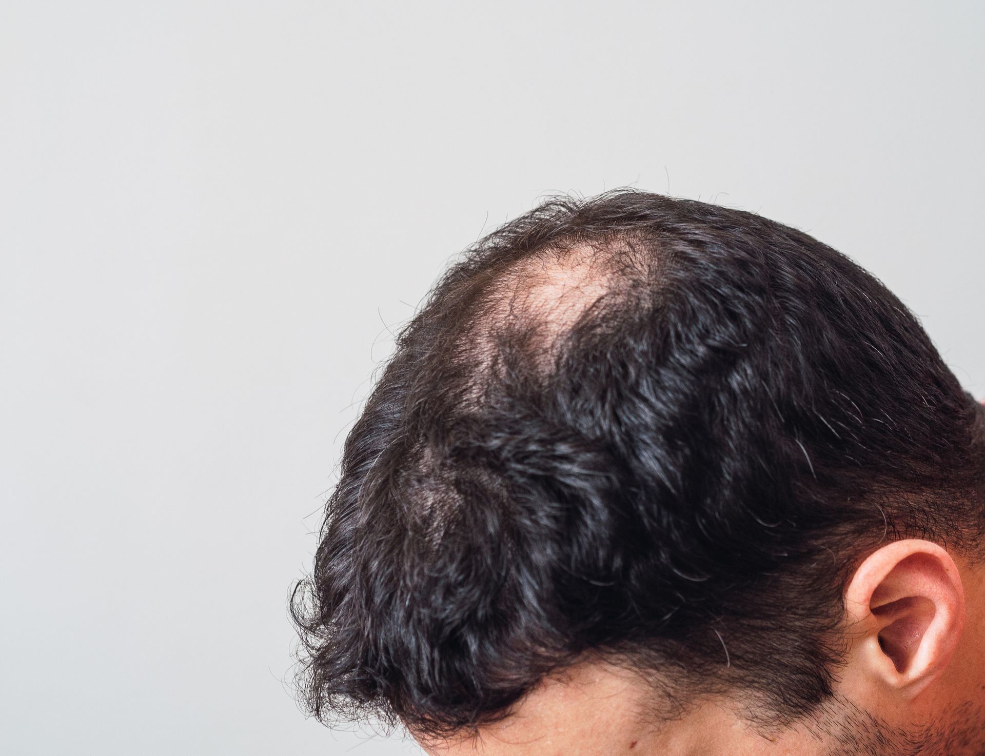 Gros plan de l'arrière de la tête d'une personne montrant des cheveux foncés clairsemés sur le sommet de la tête