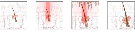 Diagram of a hair follicle being targeted with laser light for hair removal.