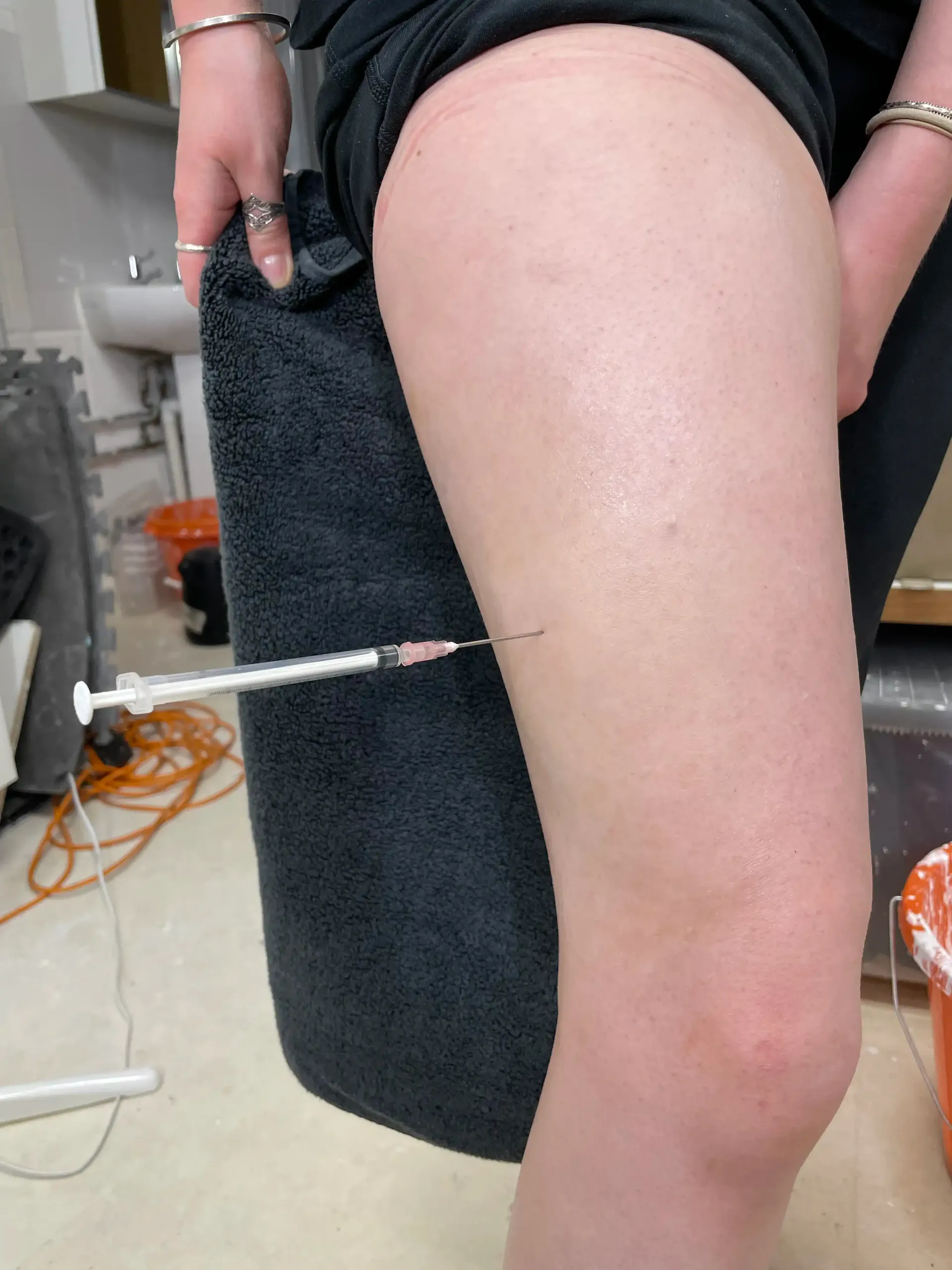 Open palm with a surgical wound exposing tendons and tissues.