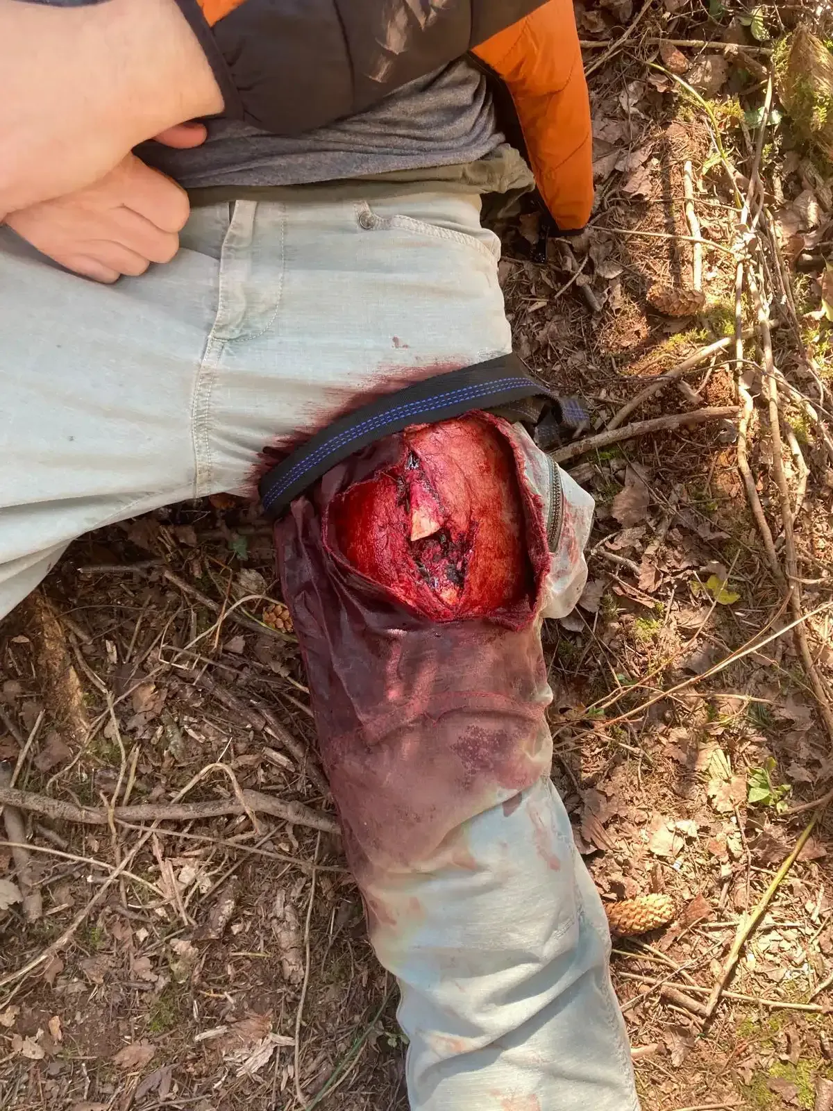Severe leg wound on a person wearing blue jeans, outdoors.