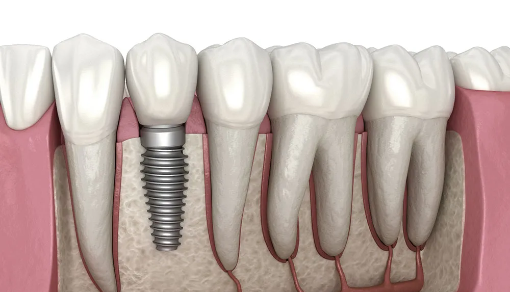 Dental implant, detailed cross-section. Metal screw implanted in jawbone, supporting a single tooth. Remaining natural teeth visible.