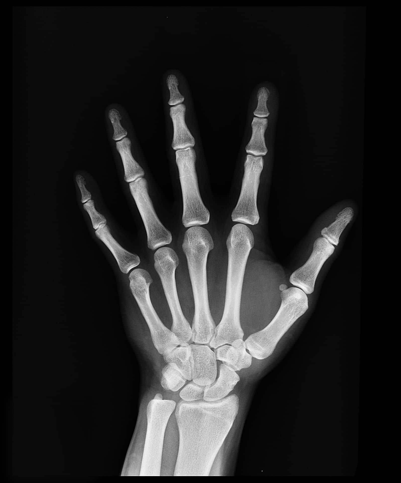 X-ray of a human hand, showing bones of the fingers, palm, and wrist against a dark background.