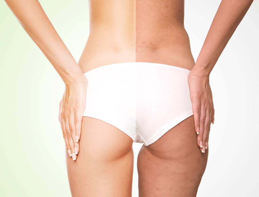 Before and After Body Retouched - Columbus, OH - Simply Sculpt