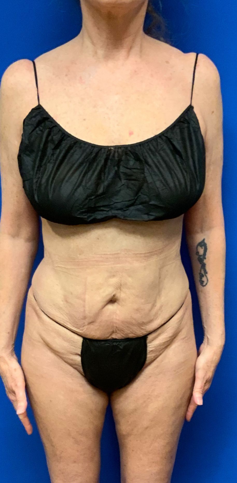 After Waist and Legs Sculpting - Columbus, OH - Simply Sculpt