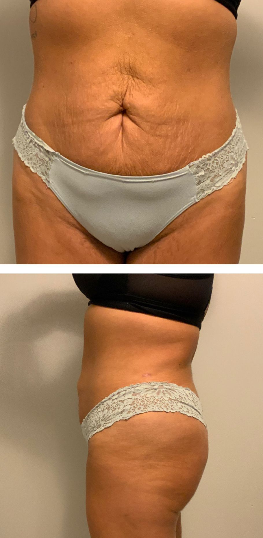 Before and After  Body Sculpting - Columbus, OH - Simply Sculpt