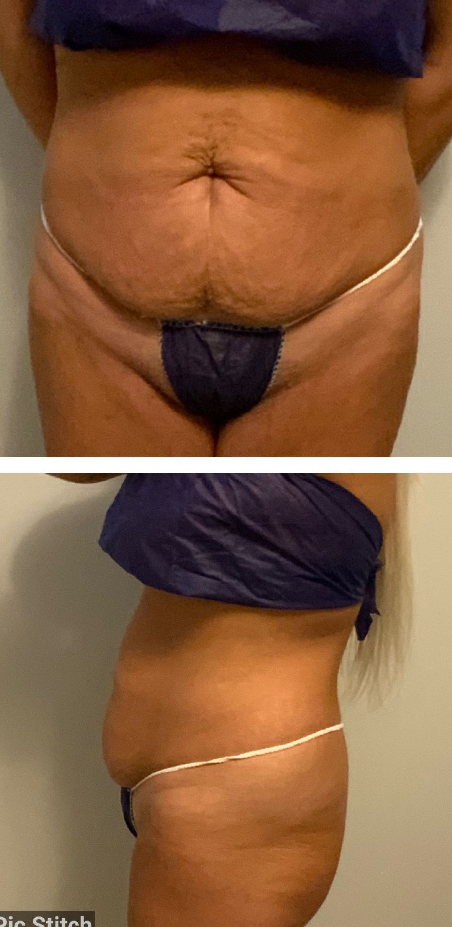 Before and After Tummy Sculpting  - Columbus, OH - Simply Sculpt