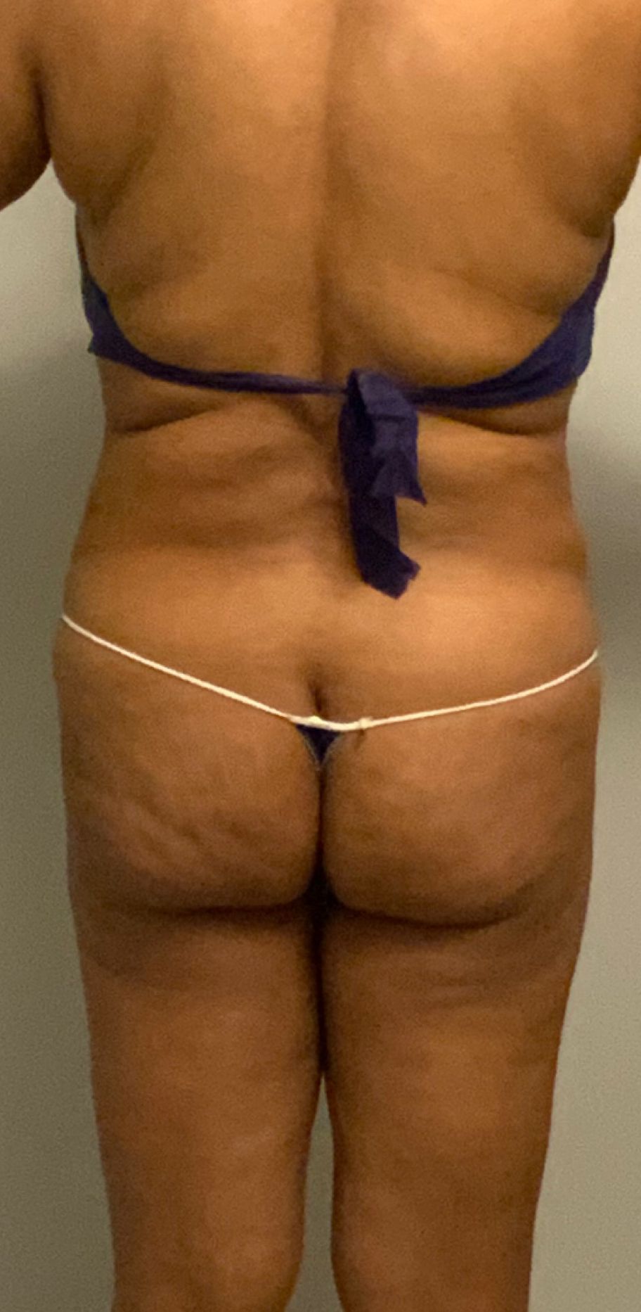 After Waist Fats Trimming - Columbus, OH - Simply Sculpt