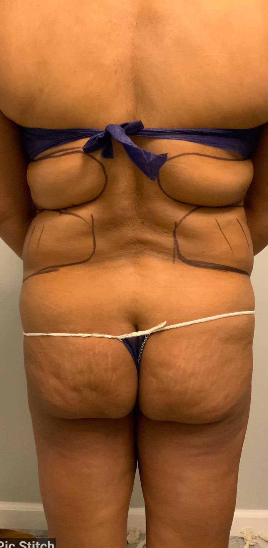 Before Waist Fats Trimming - Columbus, OH - Simply Sculpt