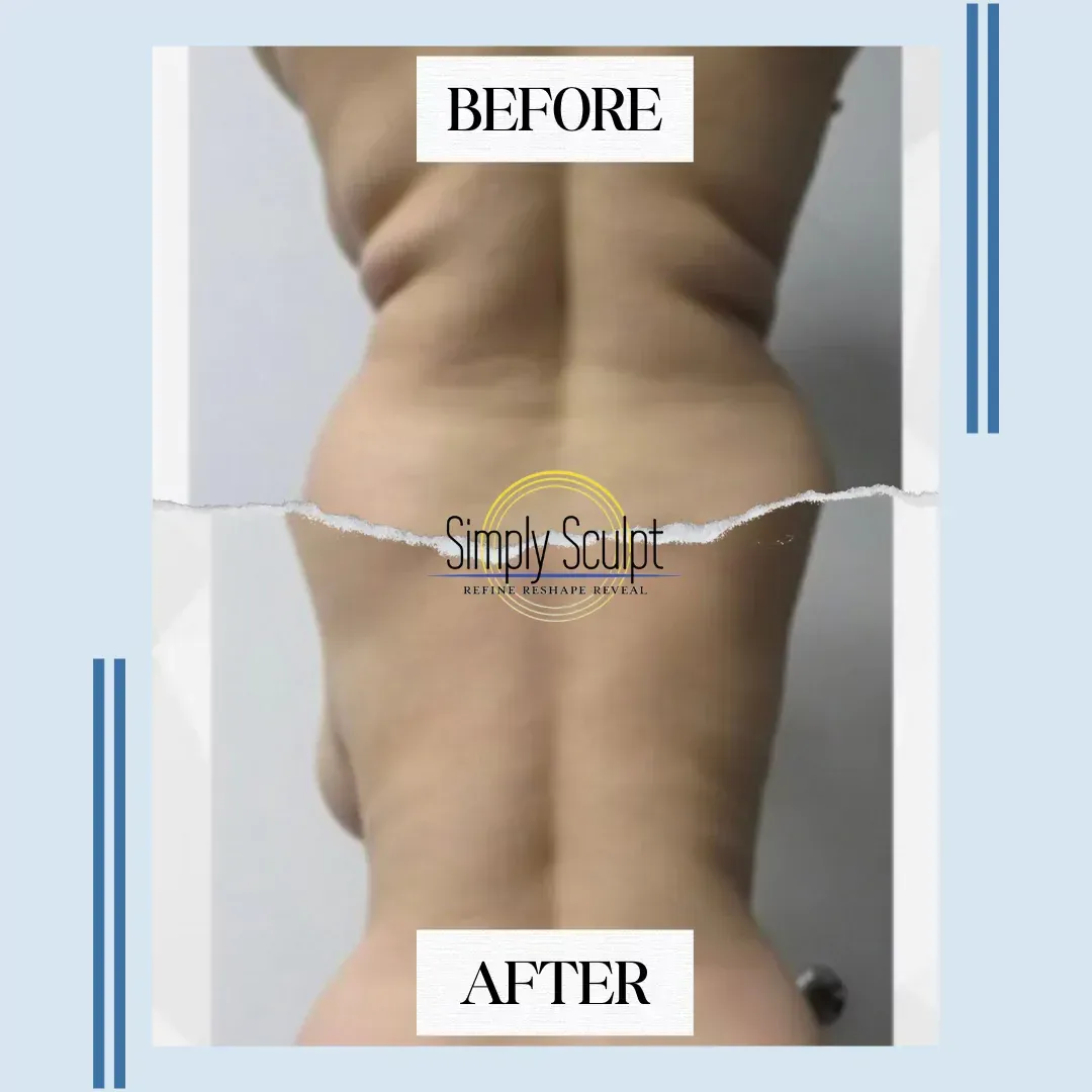 Body Contouring in Columbus, Ohio