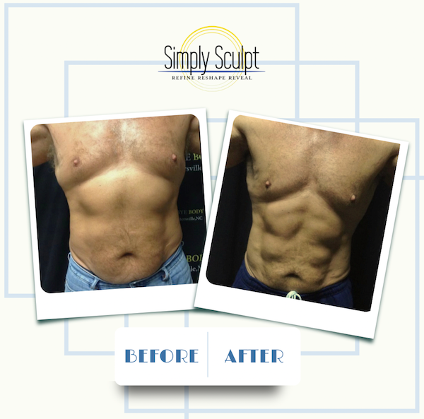 Laser Lipo in Columbus, Ohio