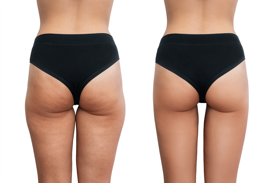 Before and After Cellulite Treatment - Columbus, OH - Simply Sculpt