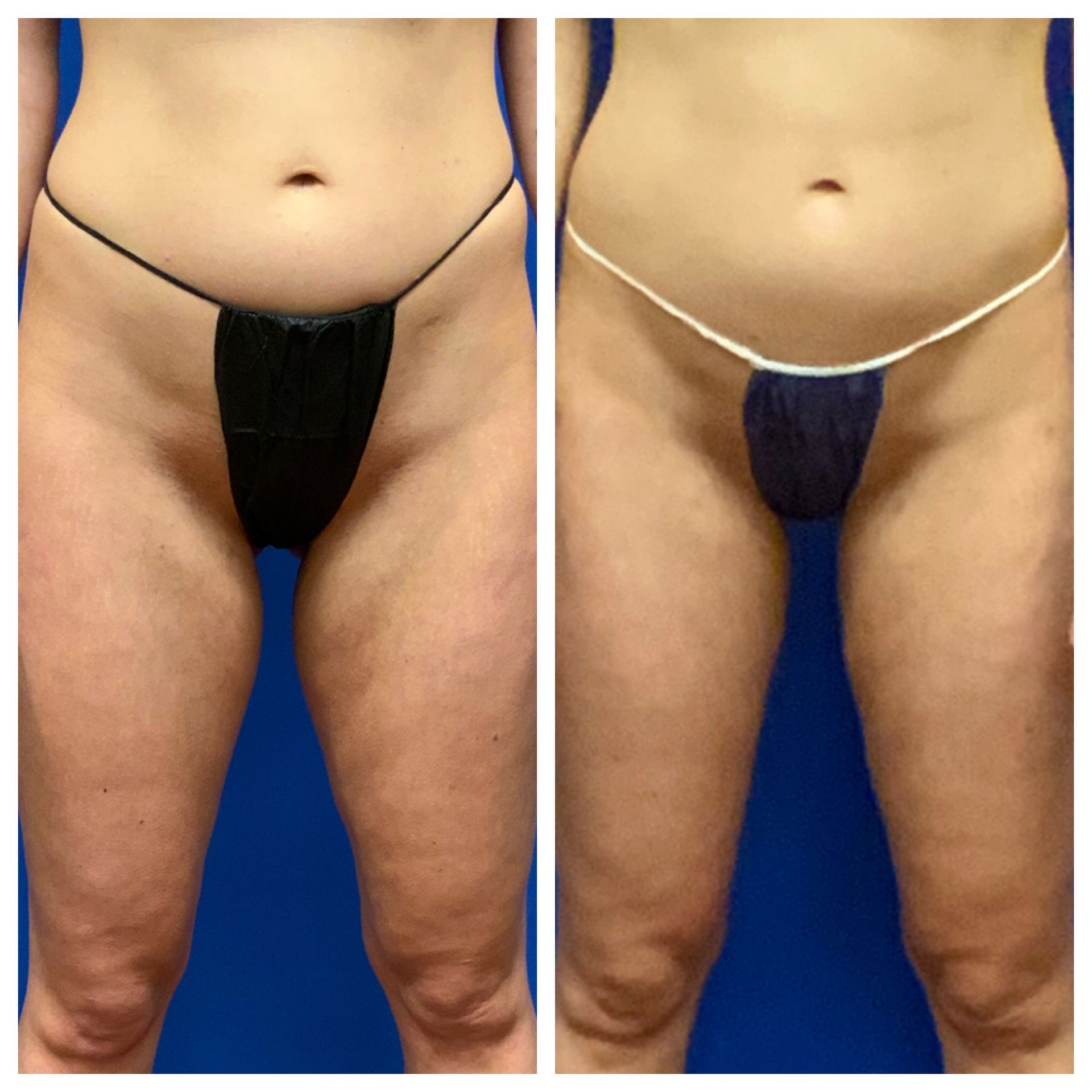 Before and After Body Trimming - Columbus, OH - Simply Sculpt