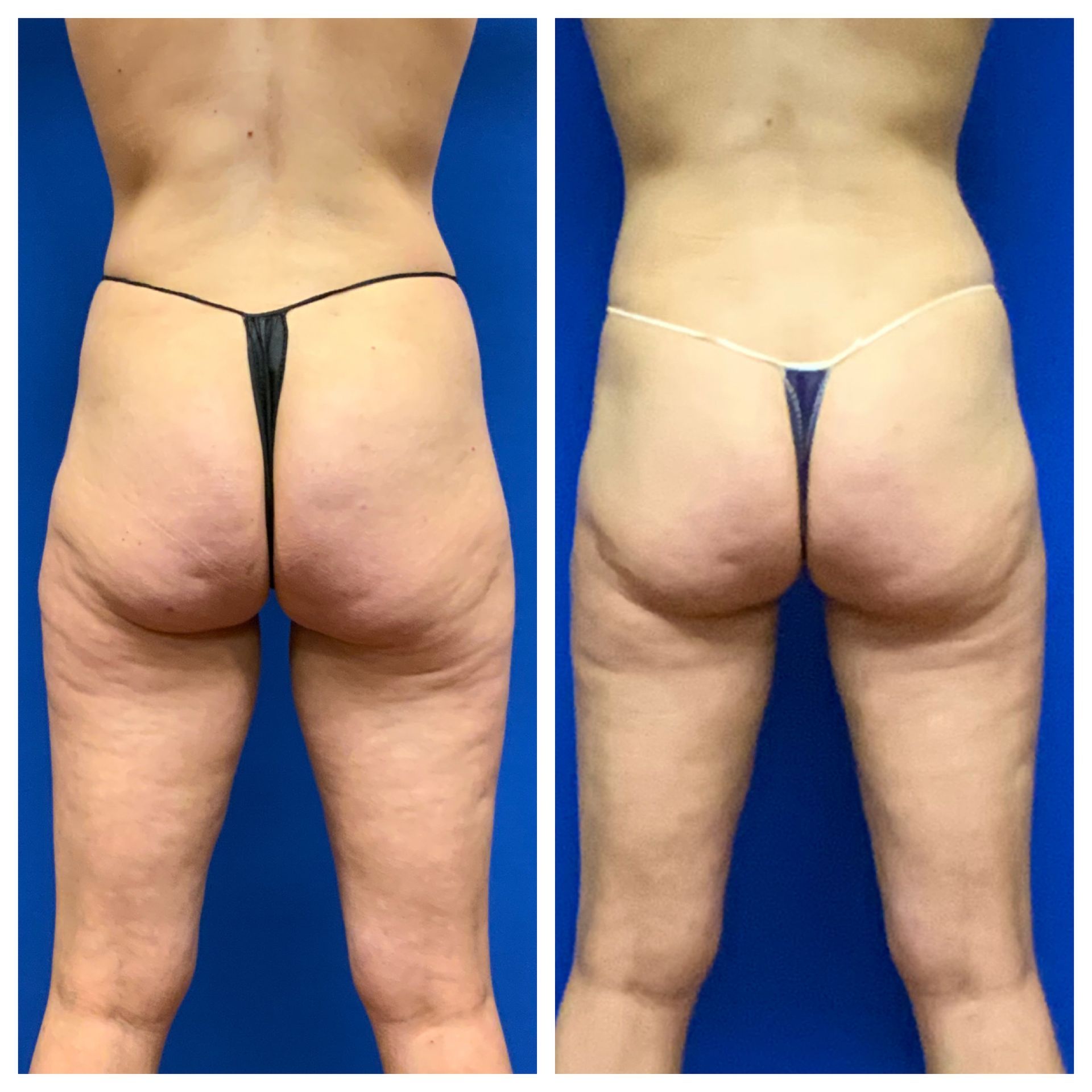 Before and After Butt Sculpting - Columbus, OH - Simply Sculpt
