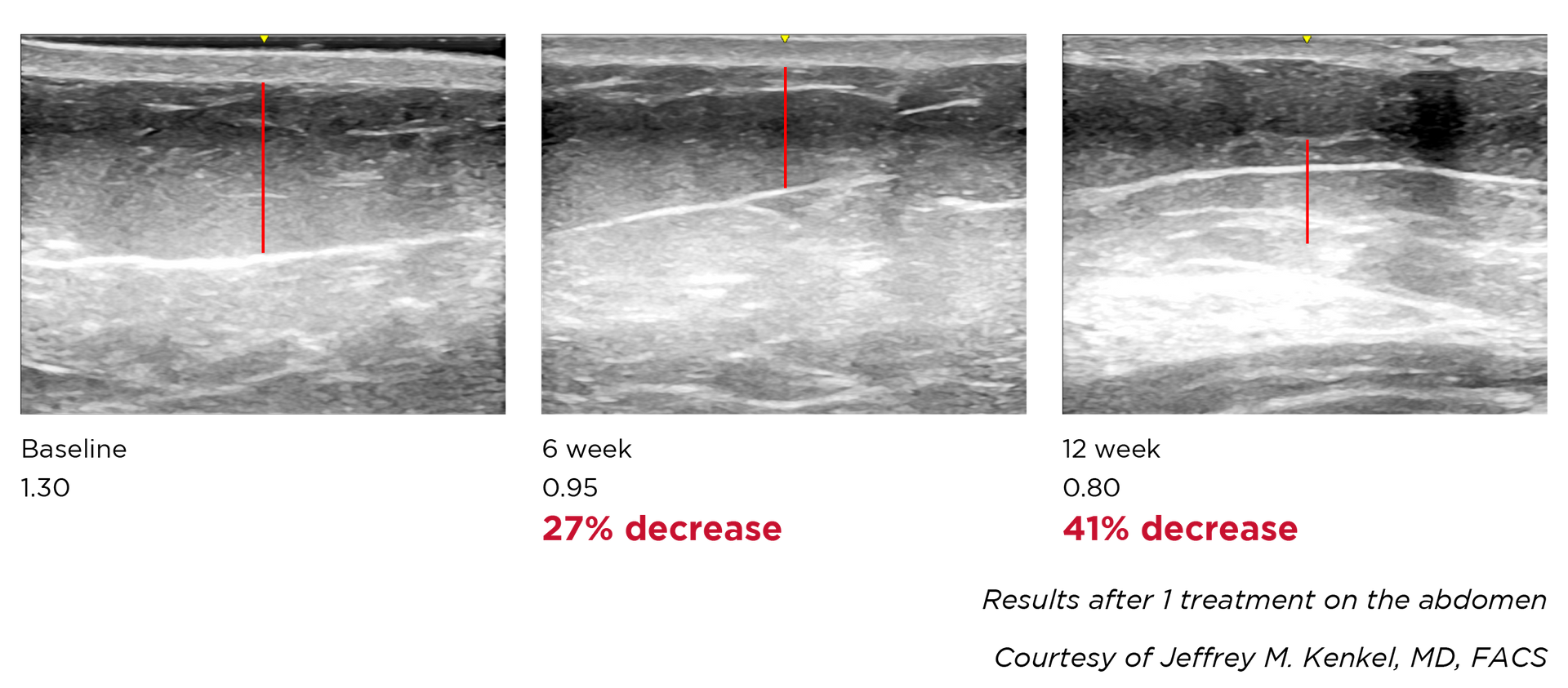 Result Of Treatment - Columbus, OH - Simply Sculpt